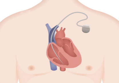 Temporary and Permanent Pacemaker