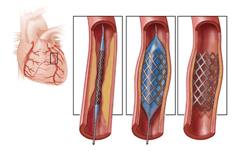 Coronary Stent Placement in Kota