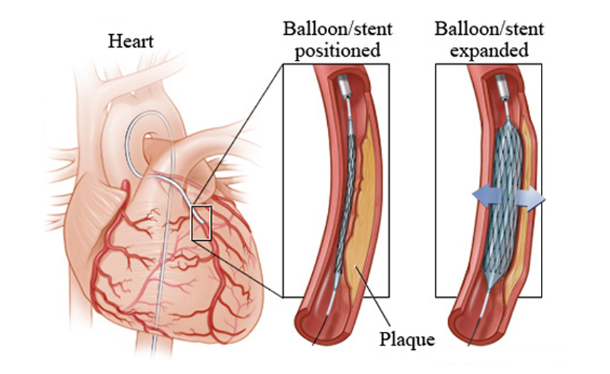 Primary Angioplasty in Kota