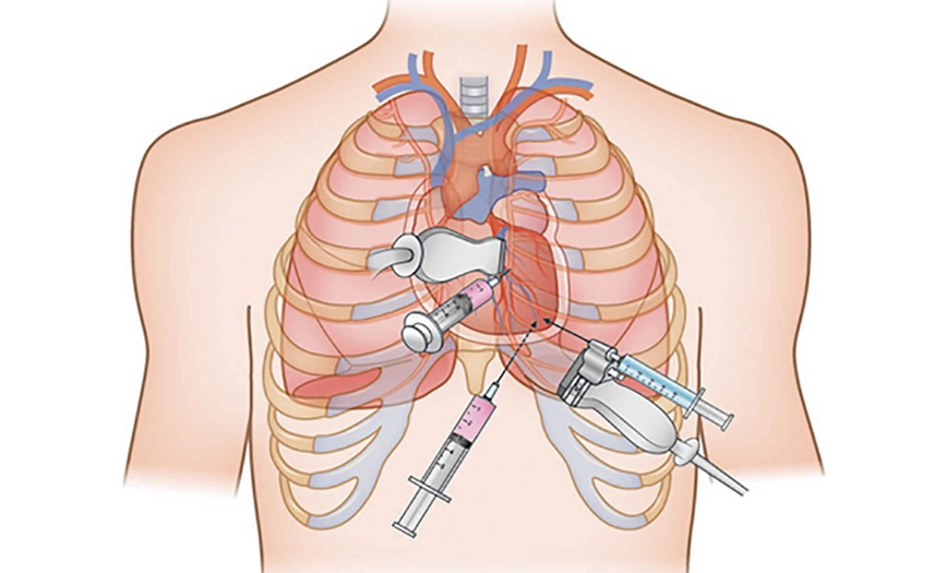 Pericardiocentesis in Kota