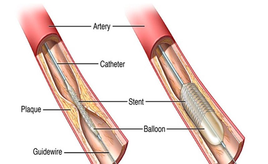 Angioplasty